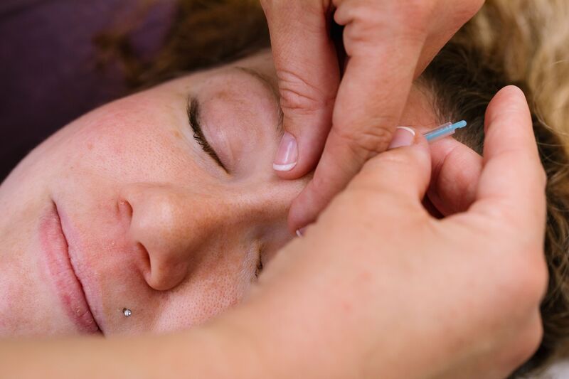 Acupuncture treatment